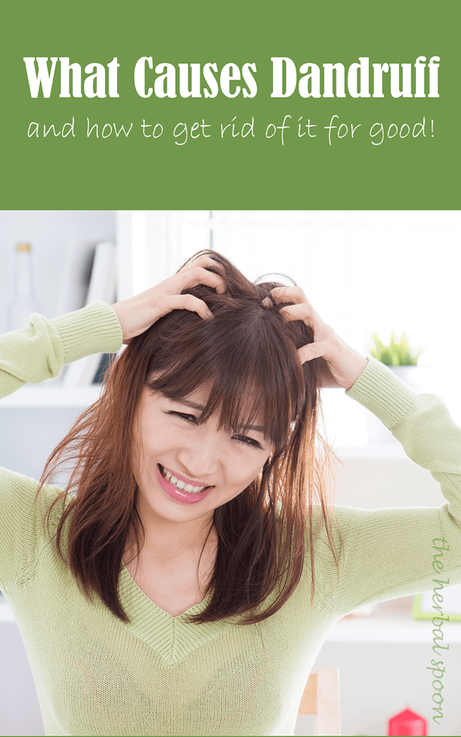 How to get rid of dandruff for good and what causes dandruff - The Herbal Spoon